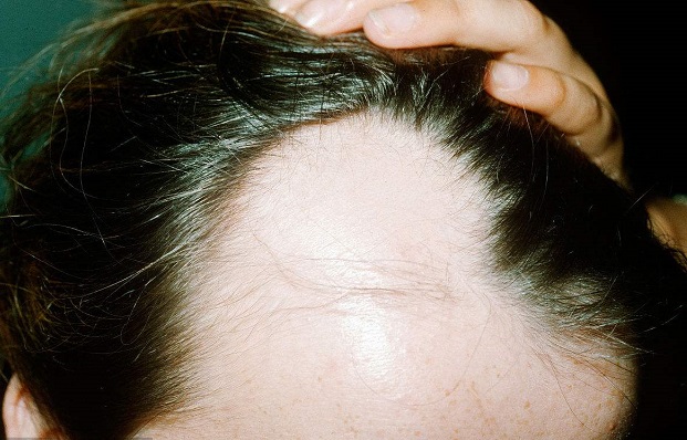 中年男子的「脱发危机」，按按头上的「帽状筋膜」就能好！