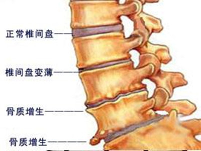颈椎腰椎骨质增生锻炼操,颈椎4-6椎体骨质增生