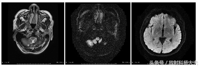想做脑部核磁但有固定假牙怎么办,做核磁需要把金属假牙拔掉吗