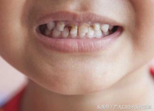 不抽烟牙齿变黑是什么原因,小孩的牙齿变黑是什么原因