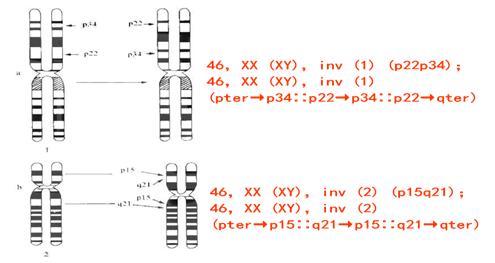 染色体异常的胎儿一定要打掉吗？