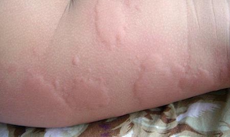 婴儿脸上疹子,婴儿疹子