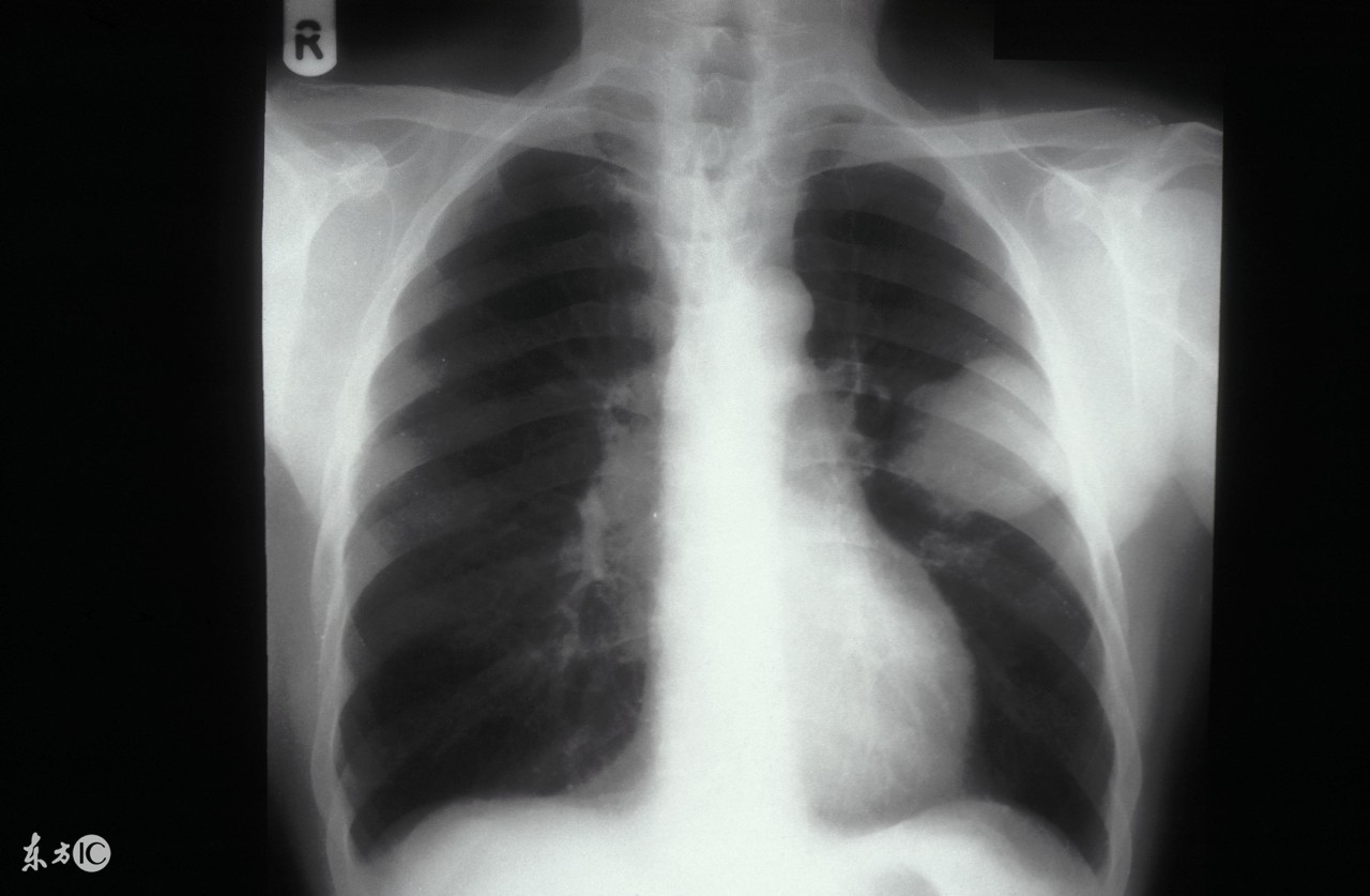 肺癌治疗不及时,肺癌微创手术后会出现哪些并发症