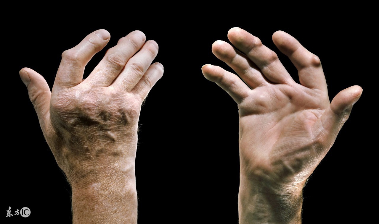 甲氨蝶呤可以治疗类风湿吗,甲氨蝶呤可以治疗类风湿