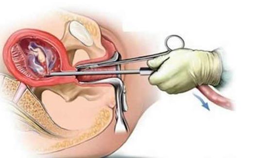 女人做无痛人流的危害,意外怀孕一个月做无痛人流好吗