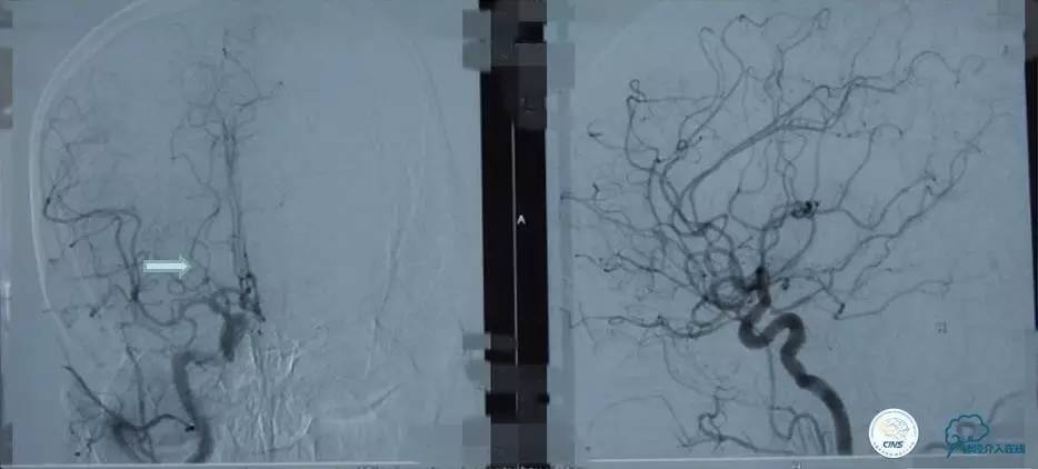 急性缺血性卒中静脉溶栓2018指南,急性缺血性卒中血管内再通标准