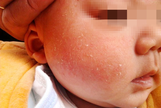 6个月婴儿手上长倒刺涂什么,宝宝手上起倒刺手指头起皮