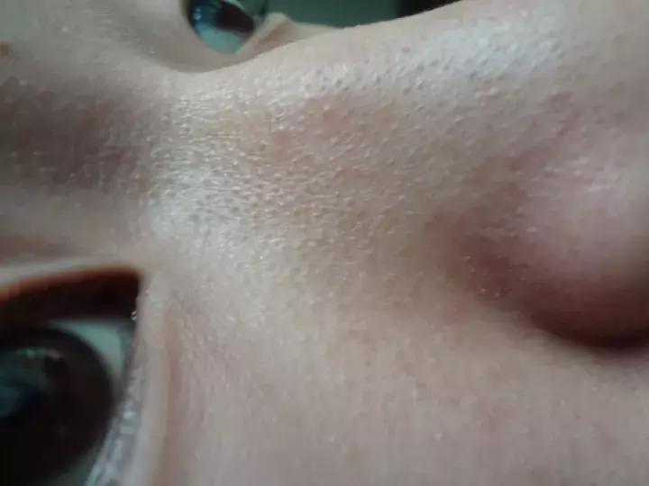 脸上小疙瘩消除最快方法,脸上小疙瘩密密麻麻怎么治疗