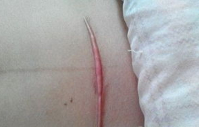 女人剖腹产两年疤痕痒痒,剖腹产刀口发痒能喝醪糟吗