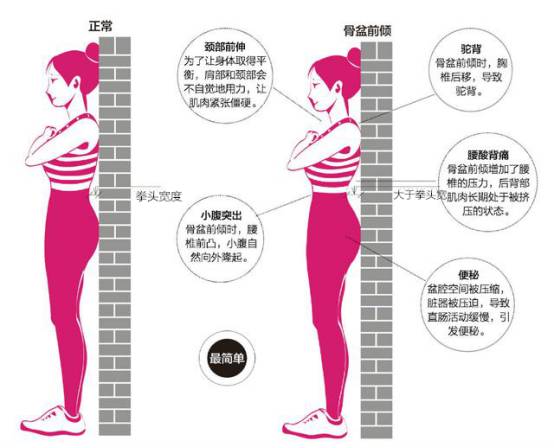 怎么判断是不是骨盆前倾矫正方法,矫正骨盆前倾的睡觉姿势