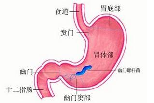 幽门螺杆菌怎么治疗可以断根中医,中医治疗幽门螺旋杆菌的中药方子