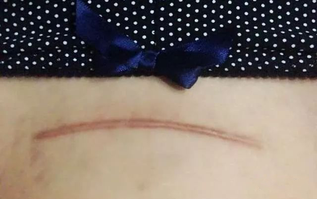 帮贝安送给你：剖腹产后9个康复小锦囊