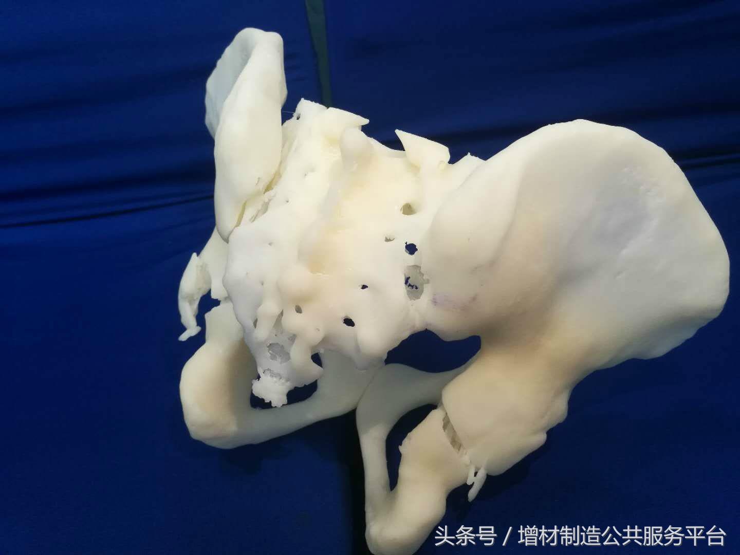 3d打印骨盆骨折成功案例,骨盆骨折抢救视频