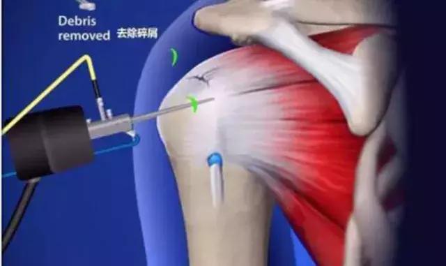 肩疼膀子疼去医院挂什么科,颈椎疼和肩疼会引起其它什么病