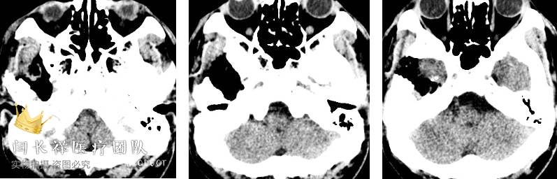 烦人的耳鸣,烦人耳鸣