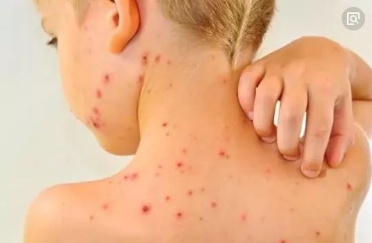 今年水痘频发怎么回事,水痘易发病时间和预防措施