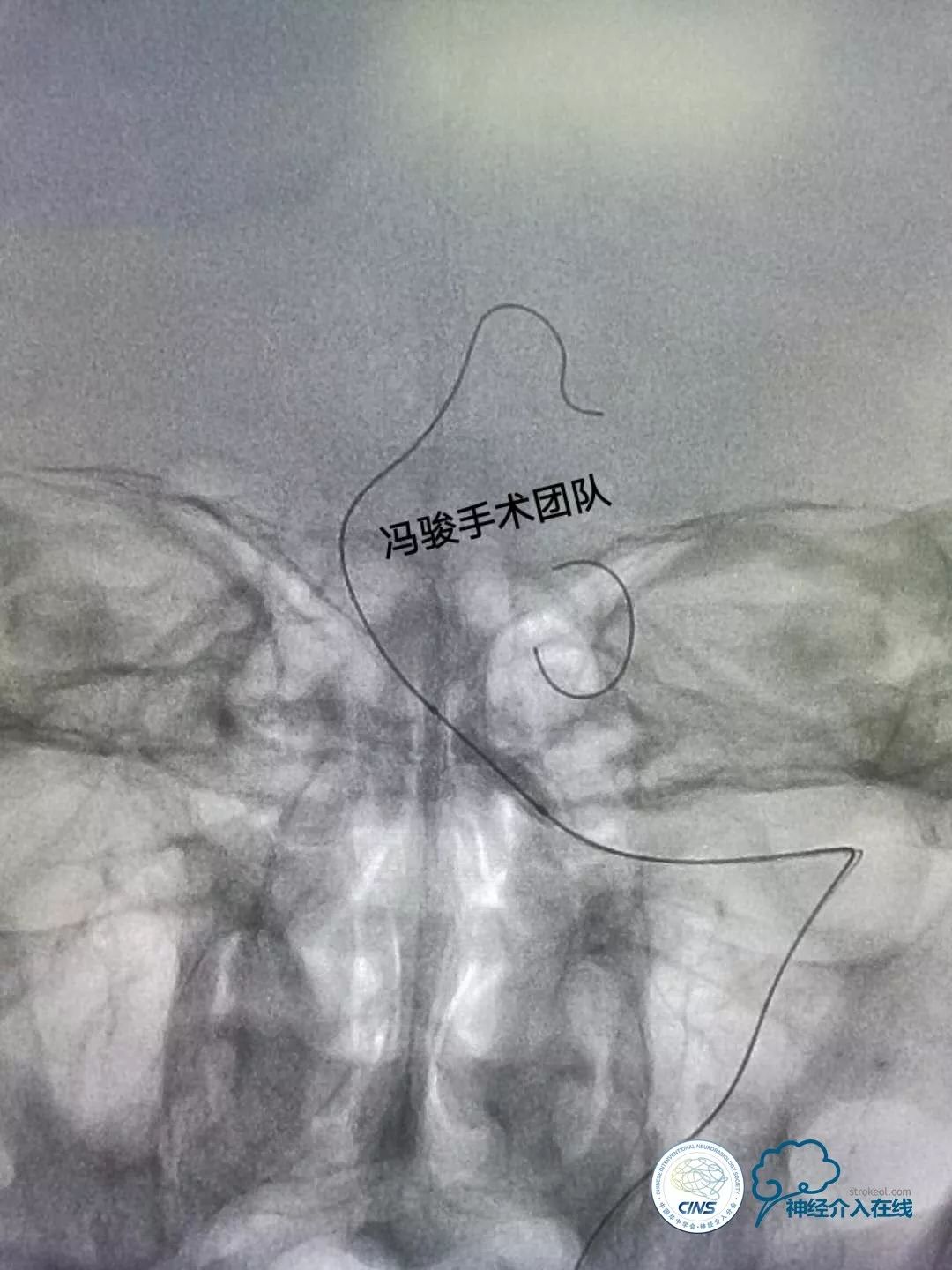 天新福—百家百言｜一例孤独椎动脉V4段并PICA重度狭窄支架手术及1年随访