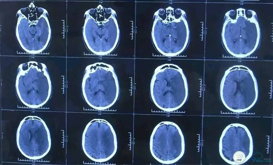 急性缺血性卒中静脉溶栓2018指南,急性缺血性卒中血管内再通标准