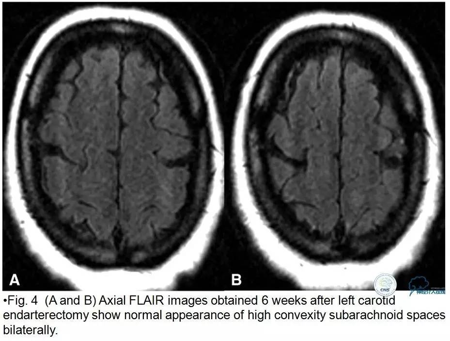 急性缺血性卒中静脉溶栓2018指南,急性缺血性卒中血管内再通标准