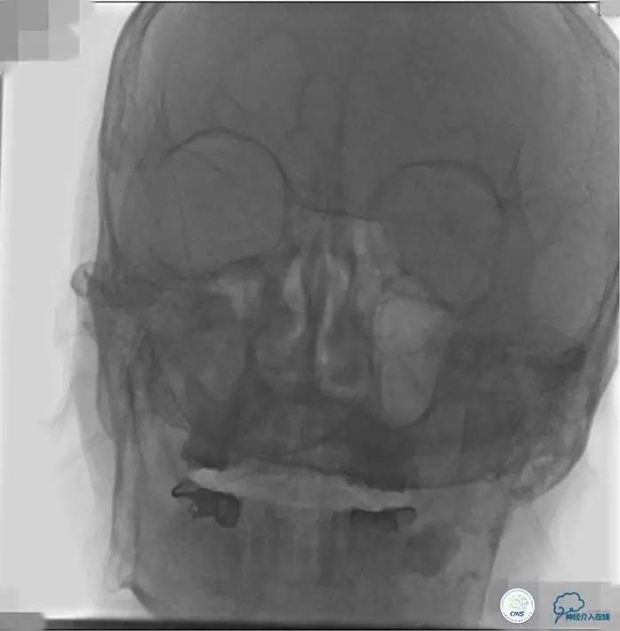急性缺血性卒中静脉溶栓2018指南,急性缺血性卒中血管内再通标准