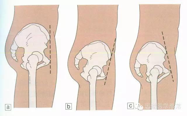 骨盆前移前倾后倾,骨盆前倾与后倾的区别瑜伽视频