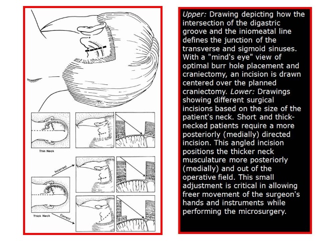 三叉神经痛和继发性的三叉神经痛,三叉神经贴治疗三叉神经痛的原理
