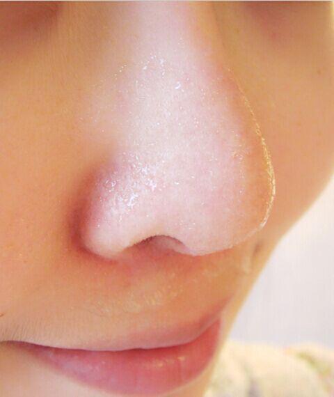 祛黑头最快最好的土方法,老中医去黑头的药膏