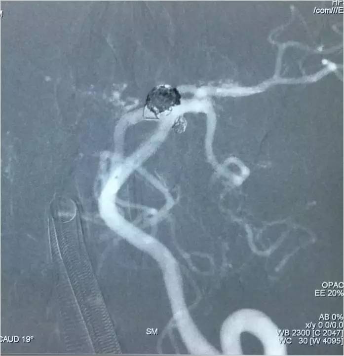 基底动脉顶端动脉瘤加左侧小脑上动脉瘤以Y型支架结合弹簧圈栓塞