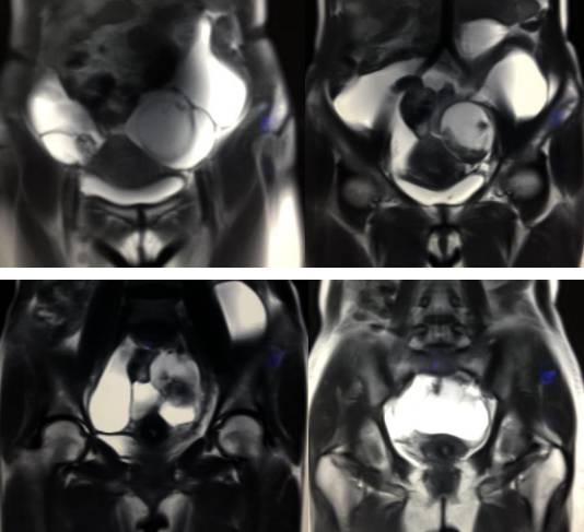 女性下腹疼痛是什么病,女性下腹疼痛的预兆