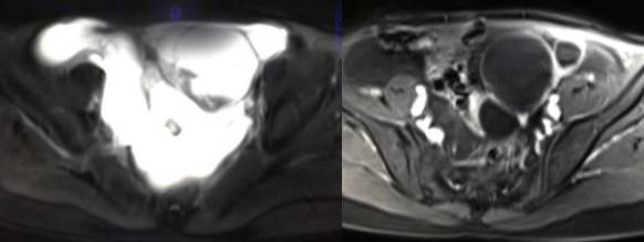 中下腹胀痛见于哪些疾病,女性下腹坠痛是不是有炎症