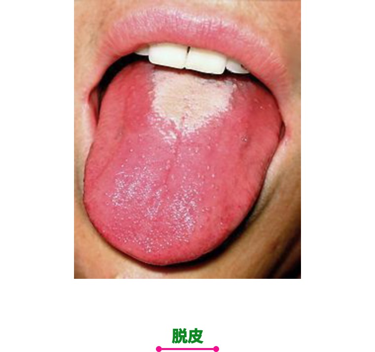 猩红热夏季,猩红热要保暖吗