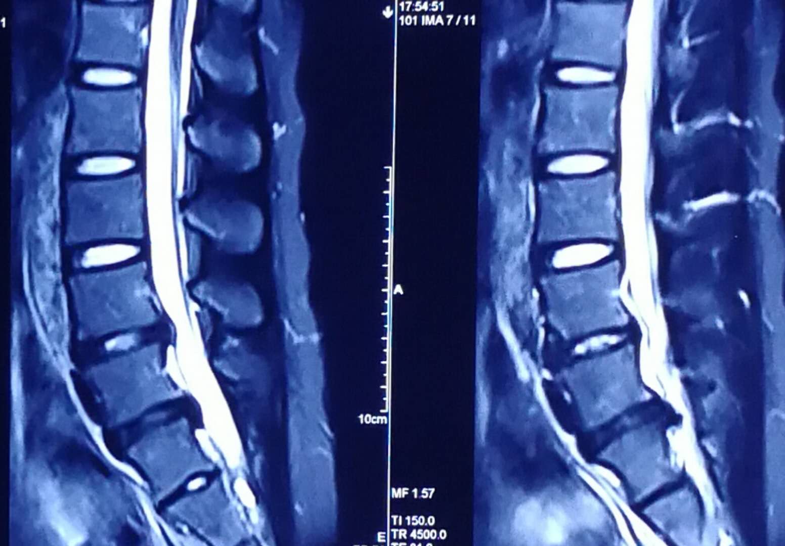 腰椎间盘突出怎么治疗好得快,女人腰椎间盘突出的亲身经历