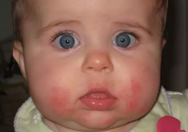 三个月口水疹最简单有效的方法,怎么预防口水疹