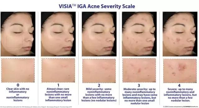 痘皮老司机的血泪经验