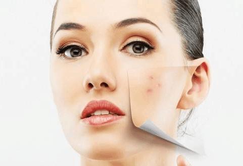 痘痘皮肤怎么护理简单方法,痘痘皮肤如何护肤