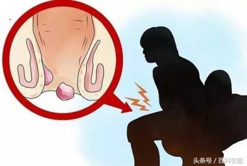 得了痔疮是什么感受疼不疼,得痔疮的亲身经历