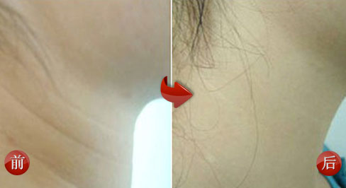 天生颈纹很深可以用颈纹霜去掉吗,出现颈纹怎么办如何有效消除颈纹