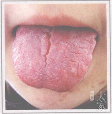 裂纹舌诊与疾病对照图,舌有裂纹六种舌象告诉你