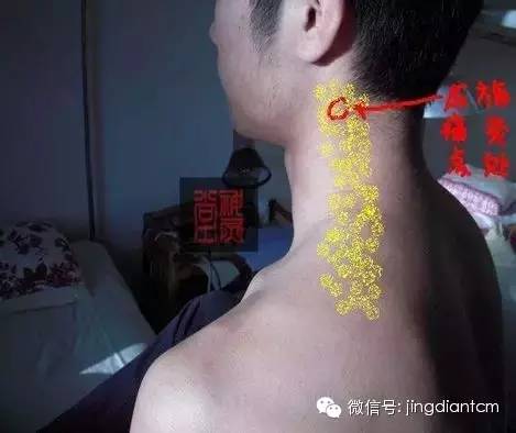 中医名家艾灸视频全集,中医艾灸知识100例