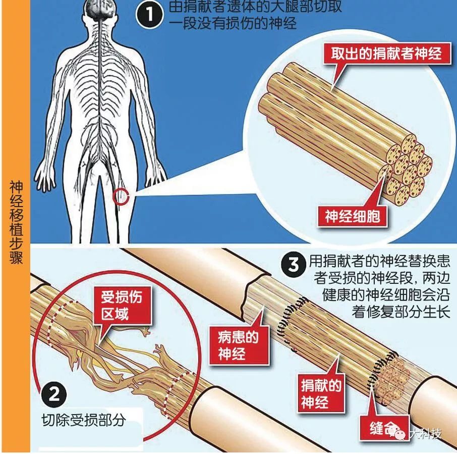 移花接木治什么病最好,移花接木令人赞叹的手术