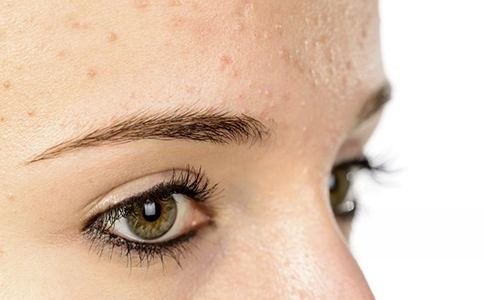 脸上长雀斑用什么洗能祛斑,祛除雀斑最有效的食疗法