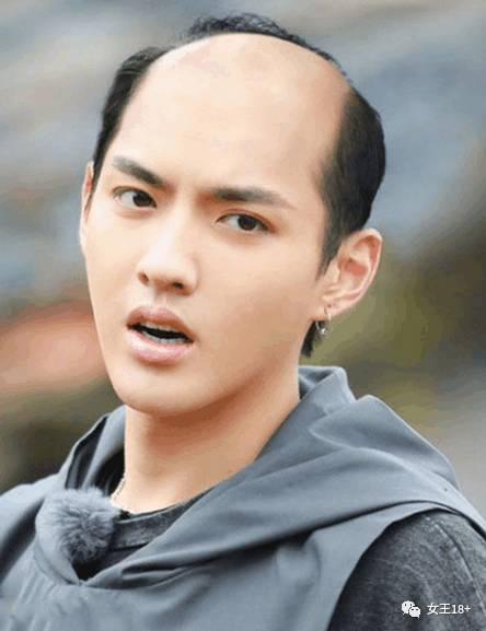 发际线后移男怎么拯救,18岁发际线后移怎么补救男