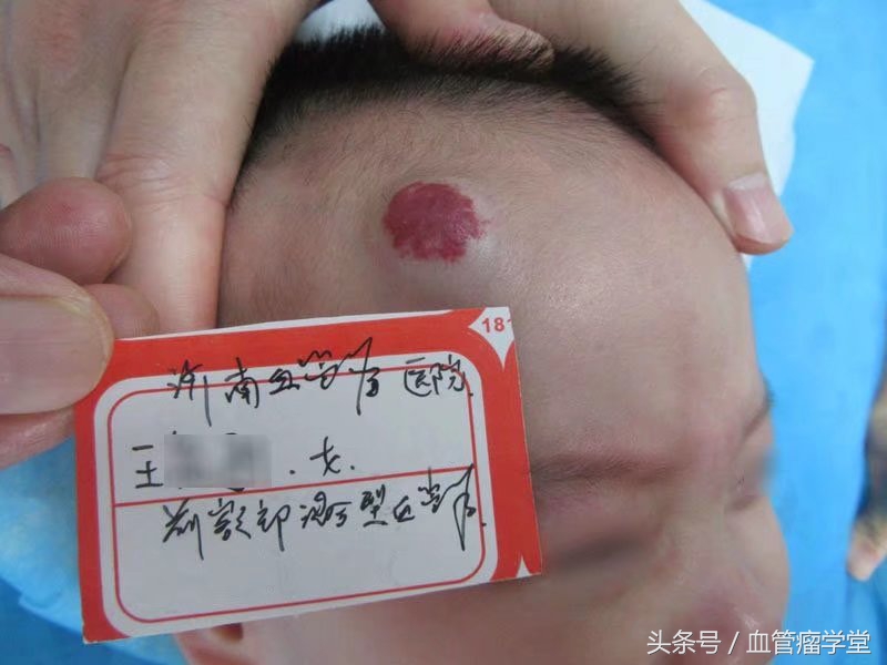 治疗血管瘤的药物普萘洛尔,普萘洛尔治疗血管瘤的剂量及方法