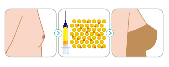 自体脂肪填充肋骨,自体脂肪填充有几种方式
