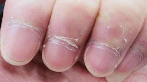 倒刺如何去除扎进手里,倒刺去除