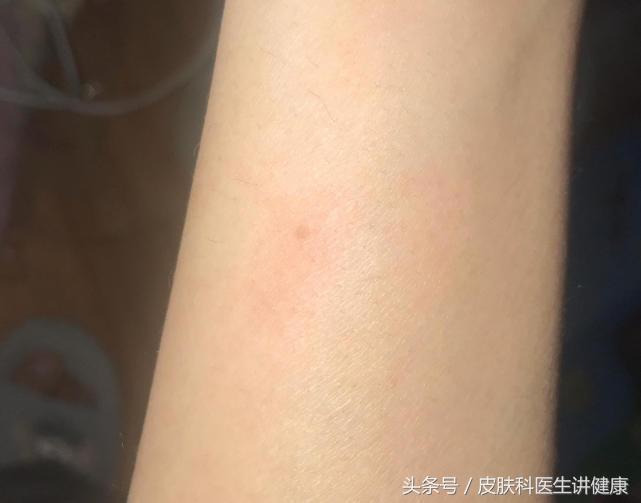 扁平疣需要治疗吗,治疗扁平疣的药膏