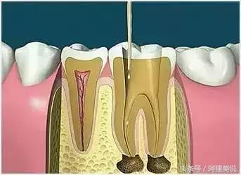 根管治疗最后补牙单独收费的吗,根管治疗最后一步需要多少钱