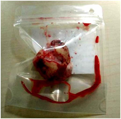 小脑幕脑膜瘤手术成功率,左侧枕部大脑镰旁脑膜瘤严重么