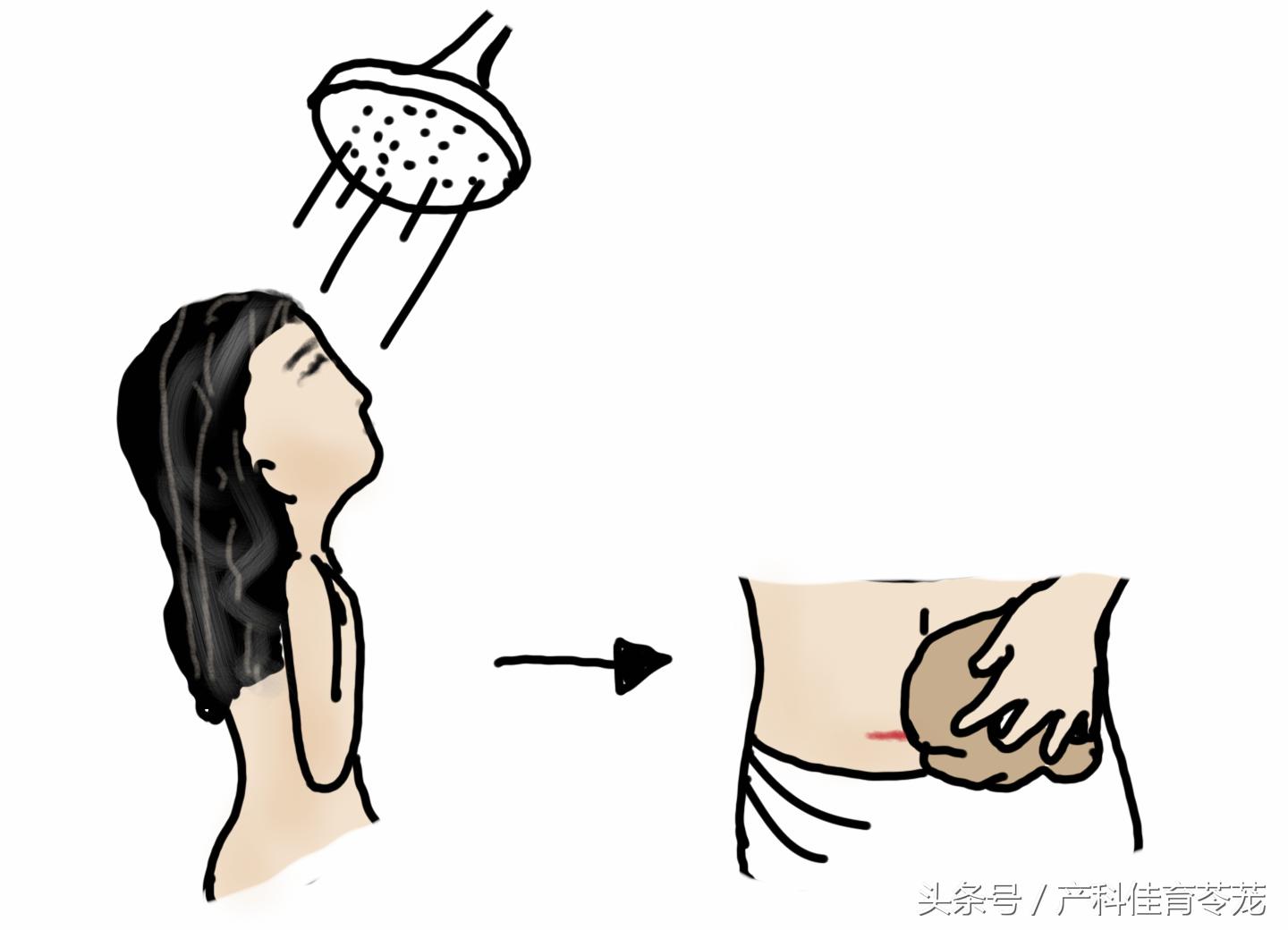 剖宫产那么大个口子，护理并不难