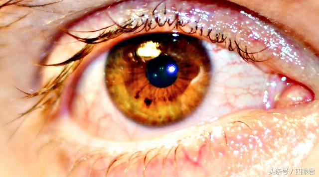 眼睛有血丝发红怎么回事,眼睛胀红眼球有血丝是什么问题